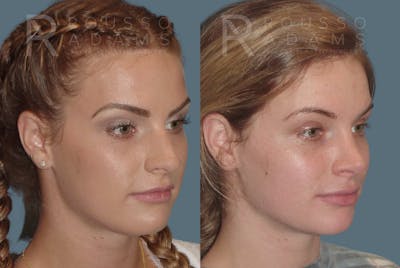 Rhinoplasty<span class=small>By Dr. Austin Adams</span> Before & After Gallery - Patient 146647202 - Image 2
