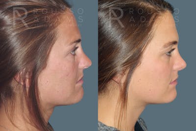 Rhinoplasty Before & After Gallery - Patient 146647203 - Image 1