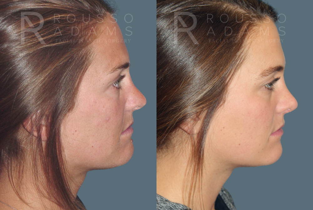 Rhinoplasty Before & After Gallery - Patient 146647203 - Image 1