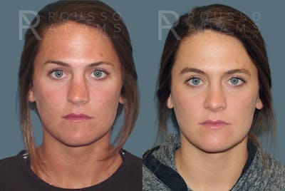 Rhinoplasty<span class=small>By Dr. Austin Adams</span> Before & After Gallery - Patient 146647203 - Image 2