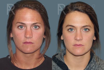 Rhinoplasty Before & After Gallery - Patient 146647203 - Image 2