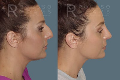 Rhinoplasty Before & After Gallery - Patient 146647204 - Image 1