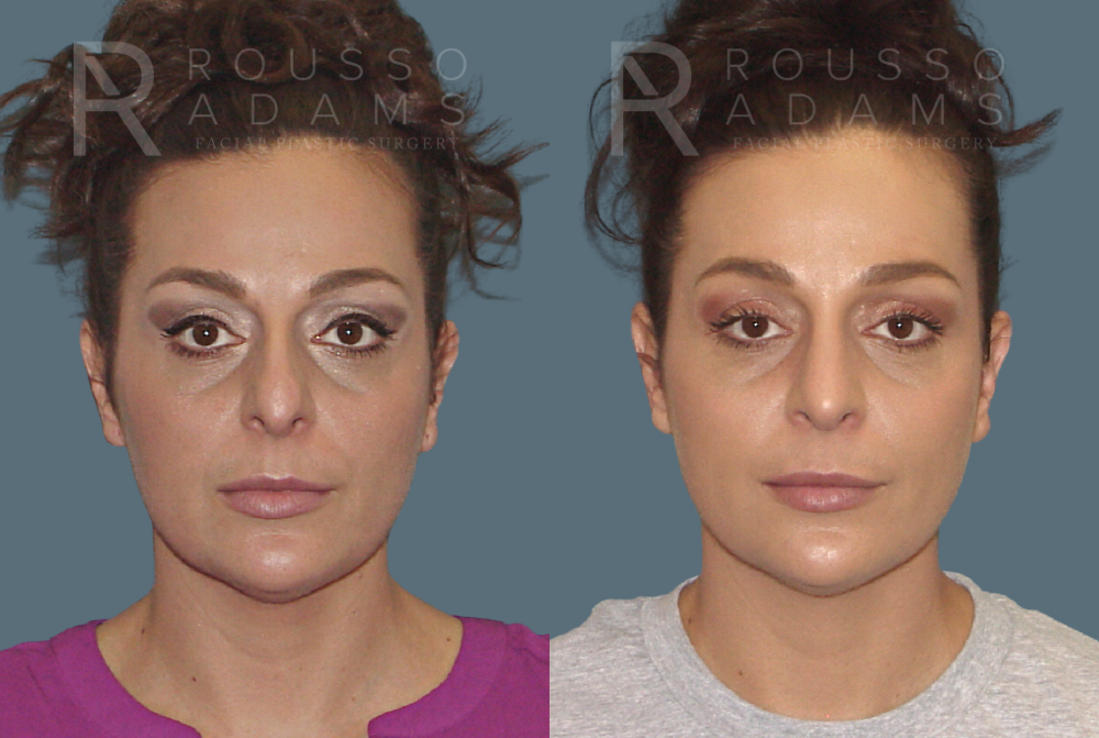 Rhinoplasty Before & After Gallery - Patient 146647204 - Image 2