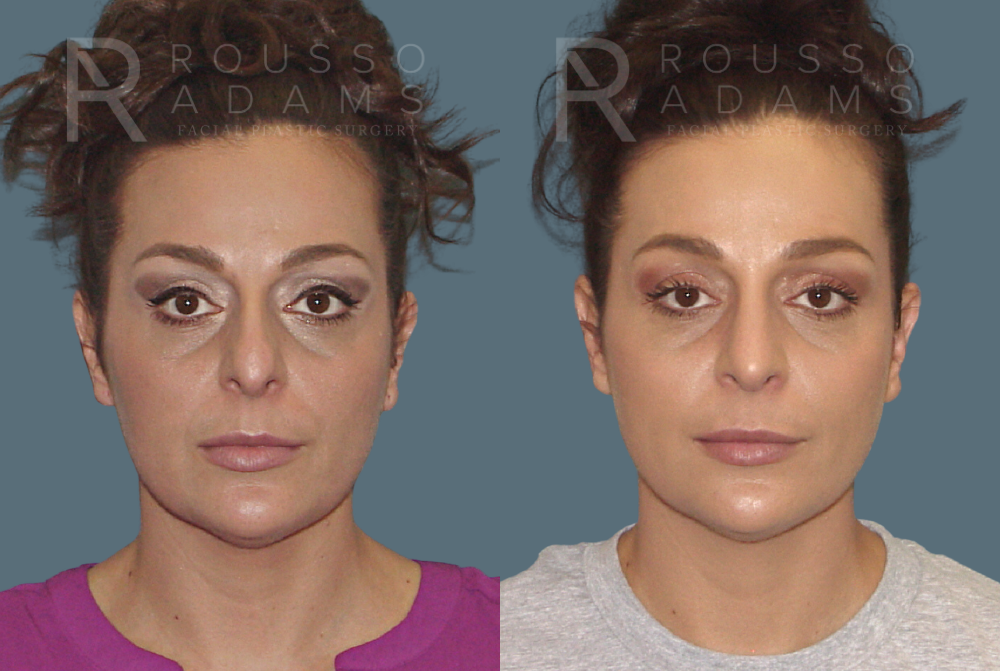 Rhinoplasty<span class=small>By Dr. Austin Adams</span> Before & After Gallery - Patient 146647204 - Image 2
