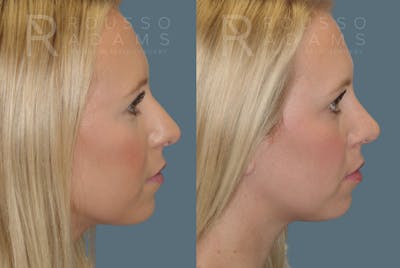 Rhinoplasty Before & After Gallery - Patient 146647205 - Image 1