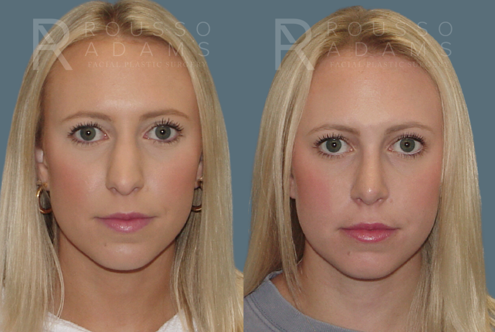 Rhinoplasty Before & After Gallery - Patient 146647205 - Image 2