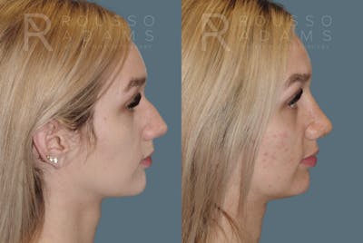 Rhinoplasty Before & After Gallery - Patient 146647206 - Image 1