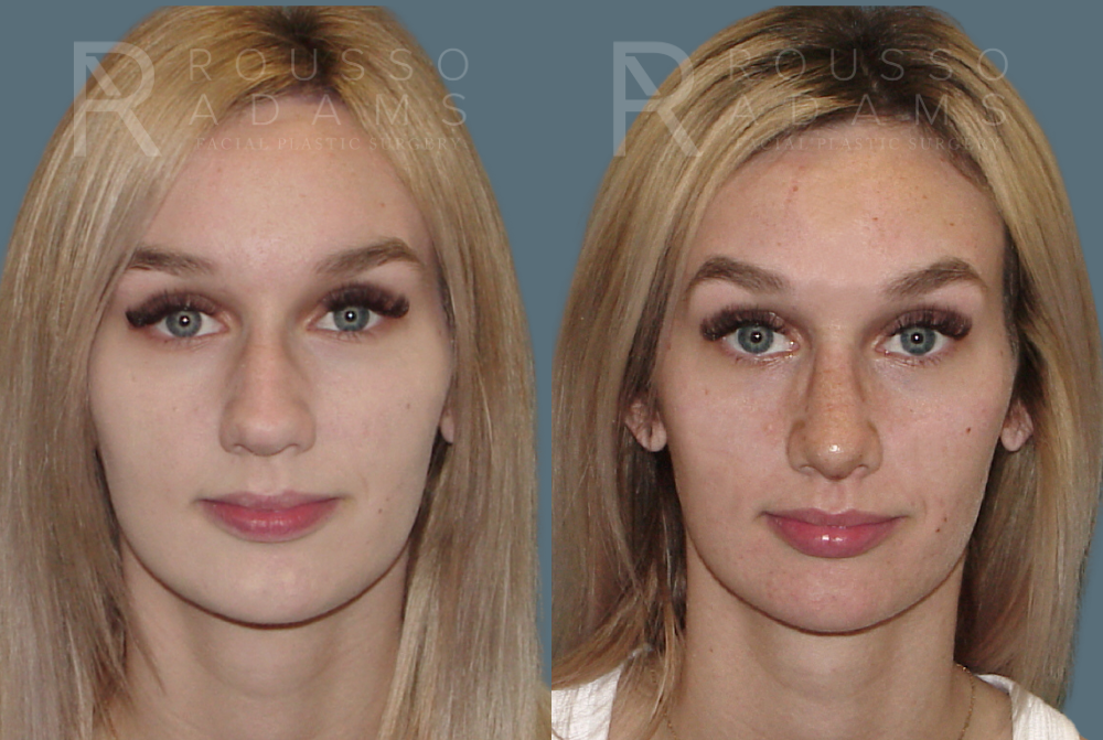 Rhinoplasty Before & After Gallery - Patient 146647206 - Image 2