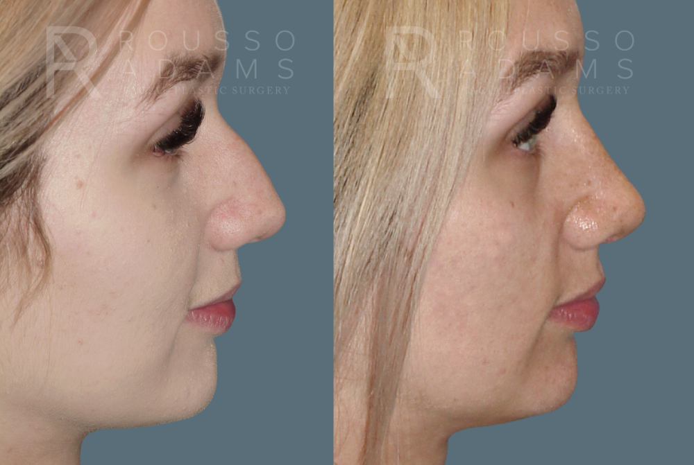 Rhinoplasty Before & After Gallery - Patient 146647206 - Image 3