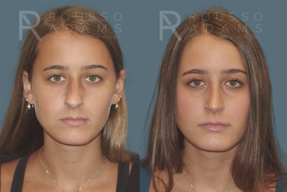 Rhinoplasty Before & After Gallery - Patient 146647207 - Image 2