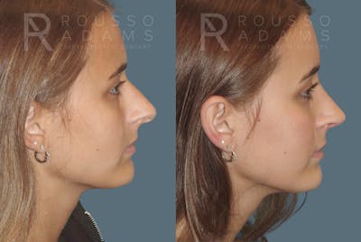 Rhinoplasty Before & After Gallery - Patient 146647207 - Image 1