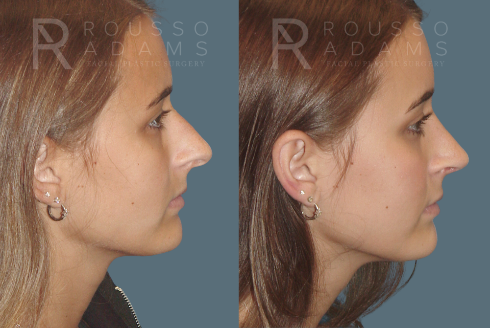 Rhinoplasty Before & After Gallery - Patient 146647207 - Image 1