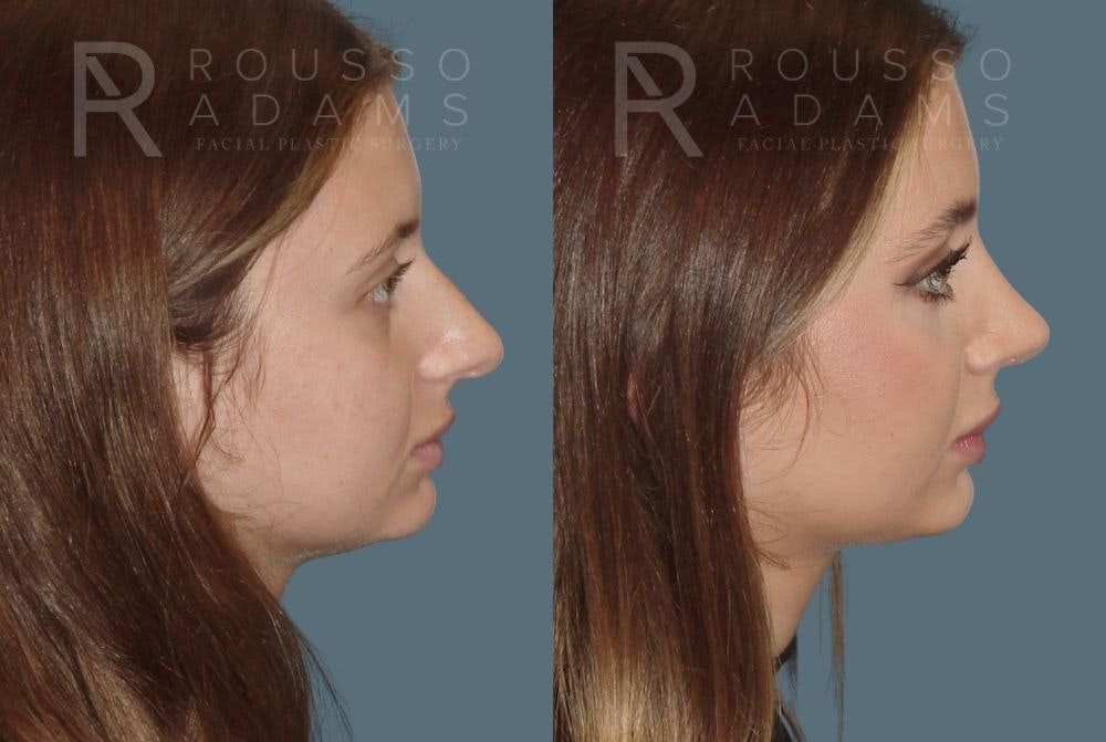 Rhinoplasty Before & After Gallery - Patient 146647208 - Image 1