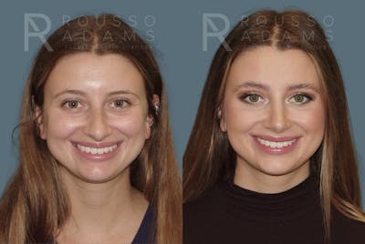 Rhinoplasty Before & After Gallery - Patient 146647208 - Image 2