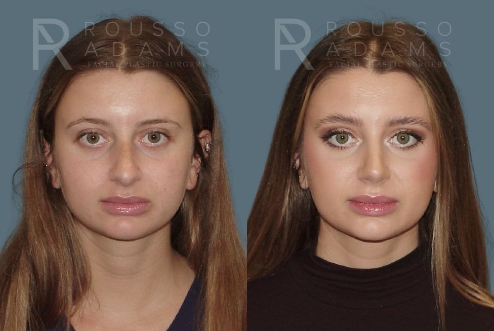 Rhinoplasty Before & After Gallery - Patient 146647208 - Image 3