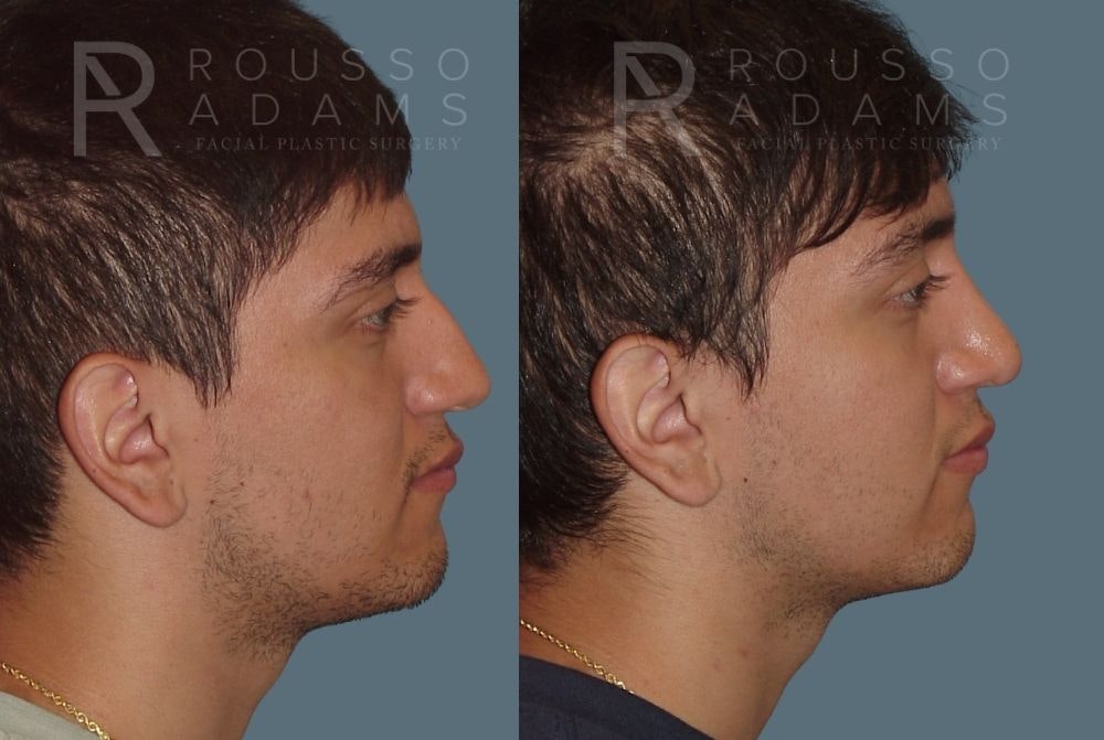 Rhinoplasty Before & After Gallery - Patient 146647209 - Image 1