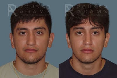 Rhinoplasty Before & After Gallery - Patient 146647209 - Image 2