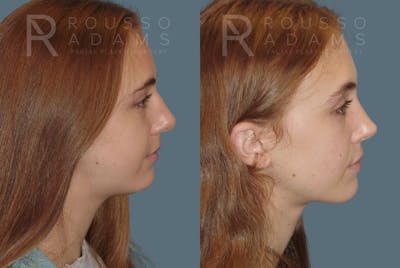 Rhinoplasty Before & After Gallery - Patient 146647210 - Image 1