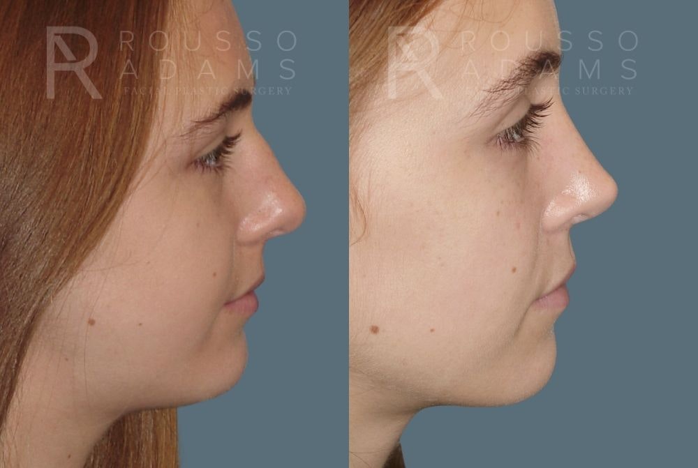 Rhinoplasty Before & After Gallery - Patient 146647210 - Image 2