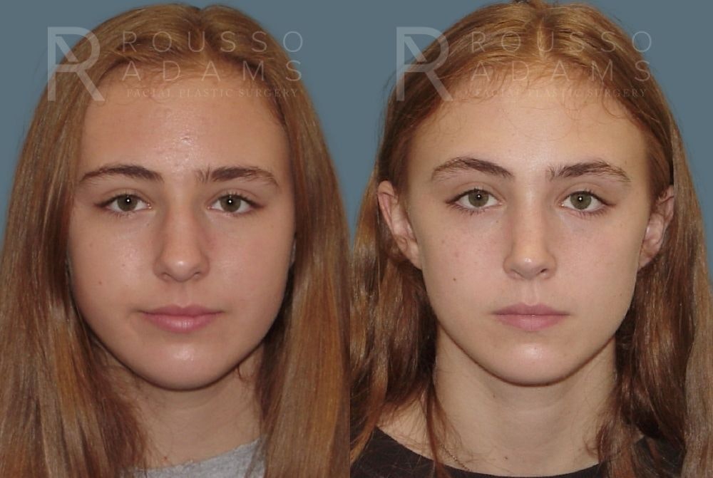 Rhinoplasty Before & After Gallery - Patient 146647210 - Image 3