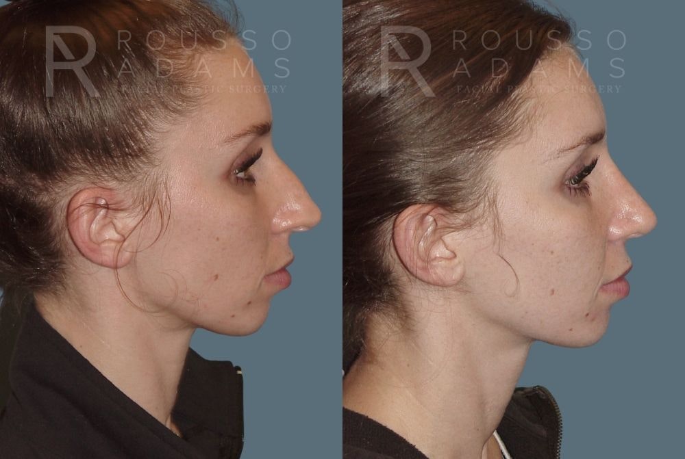 Rhinoplasty Before & After Gallery - Patient 146647211 - Image 1