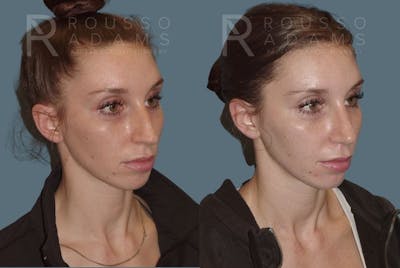 Rhinoplasty Before & After Gallery - Patient 146647211 - Image 2