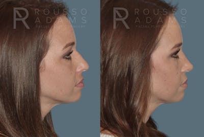 Rhinoplasty Before & After Gallery - Patient 146647212 - Image 1