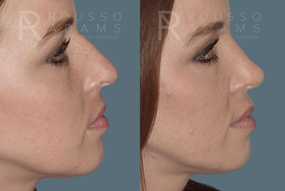 Rhinoplasty Before & After Gallery - Patient 146647212 - Image 2