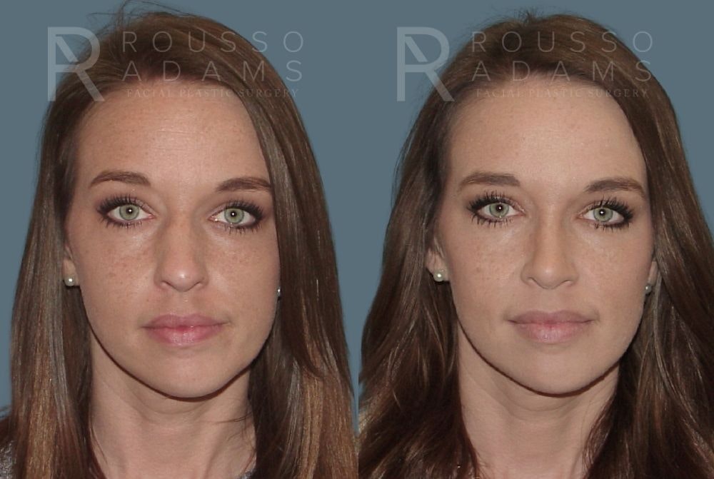 Rhinoplasty Before & After Gallery - Patient 146647212 - Image 3