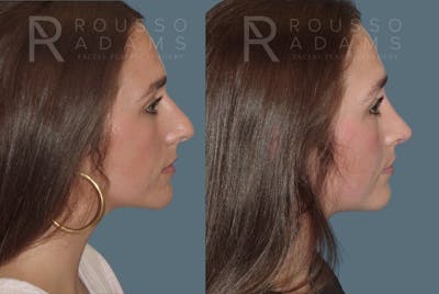 Rhinoplasty Before & After Gallery - Patient 146647213 - Image 1