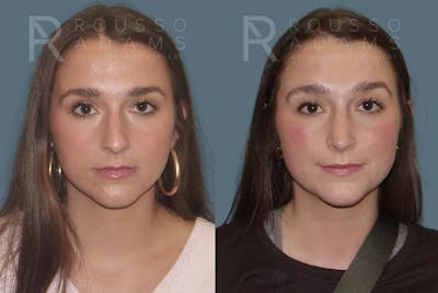 Rhinoplasty Before & After Gallery - Patient 146647213 - Image 2