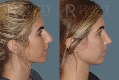 Rhinoplasty Before & After Gallery - Patient 146647214 - Image 1