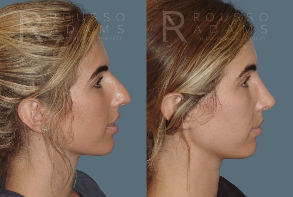 Rhinoplasty Before & After Gallery - Patient 146647214 - Image 1