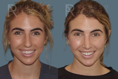 Rhinoplasty Before & After Gallery - Patient 146647214 - Image 2