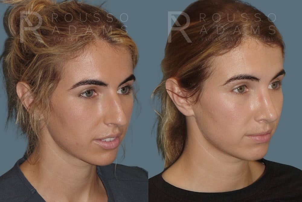 Rhinoplasty Before & After Gallery - Patient 146647214 - Image 3
