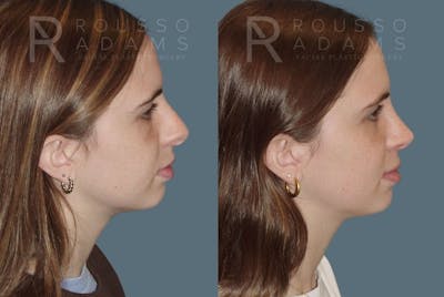 Rhinoplasty Before & After Gallery - Patient 146647215 - Image 1