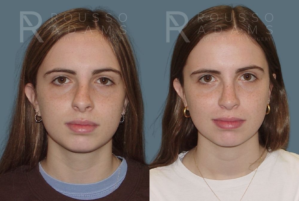 Rhinoplasty Before & After Gallery - Patient 146647215 - Image 2