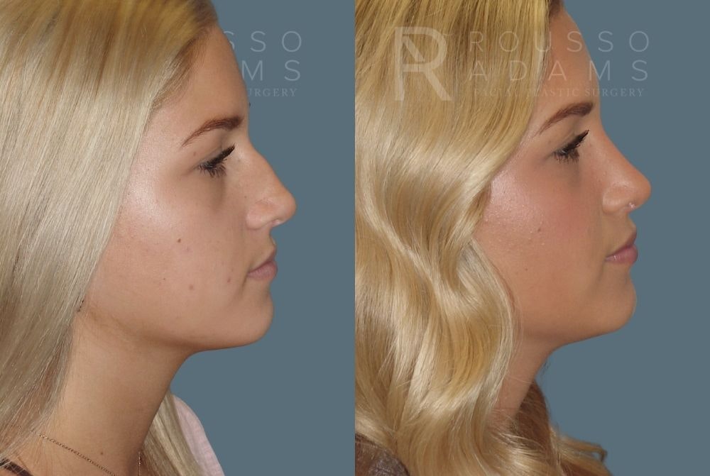 Rhinoplasty Before & After Gallery - Patient 146647216 - Image 1