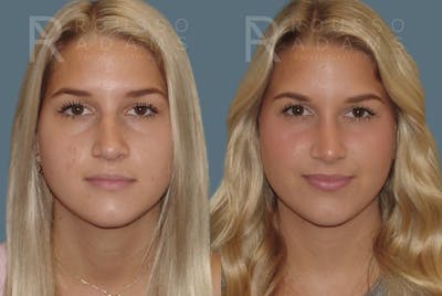 Rhinoplasty Before & After Gallery - Patient 146647216 - Image 2