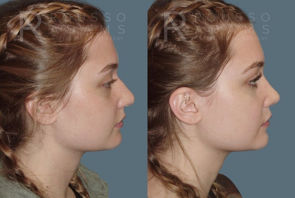 Rhinoplasty Before & After Gallery - Patient 146647217 - Image 1