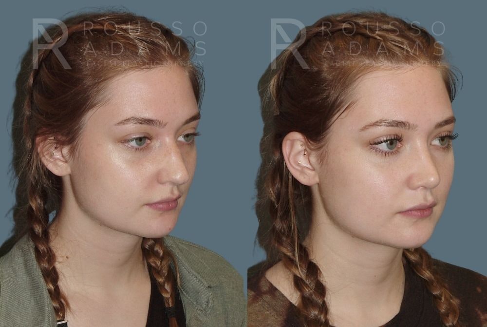 Rhinoplasty Before & After Gallery - Patient 146647217 - Image 2