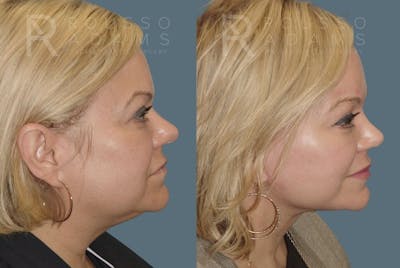 Rhinoplasty Before & After Gallery - Patient 146647218 - Image 1