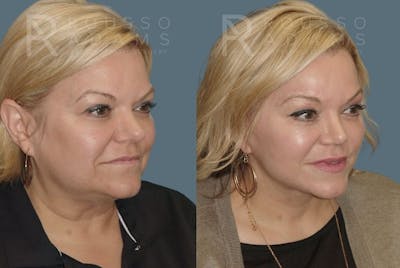 Rhinoplasty Before & After Gallery - Patient 146647218 - Image 2
