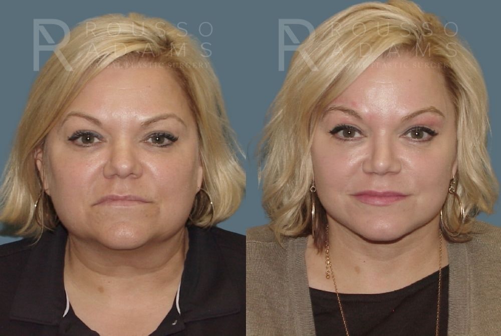 Rhinoplasty Before & After Gallery - Patient 146647218 - Image 3