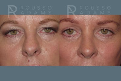 Blepharoplasty Before & After Gallery - Patient 146647263 - Image 1