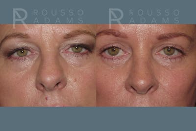 Blepharoplasty<span class=small>By Dr. Austin Adams</span> Before & After Gallery - Patient 146647263 - Image 1