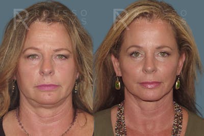 Blepharoplasty Before & After Gallery - Patient 146647263 - Image 2
