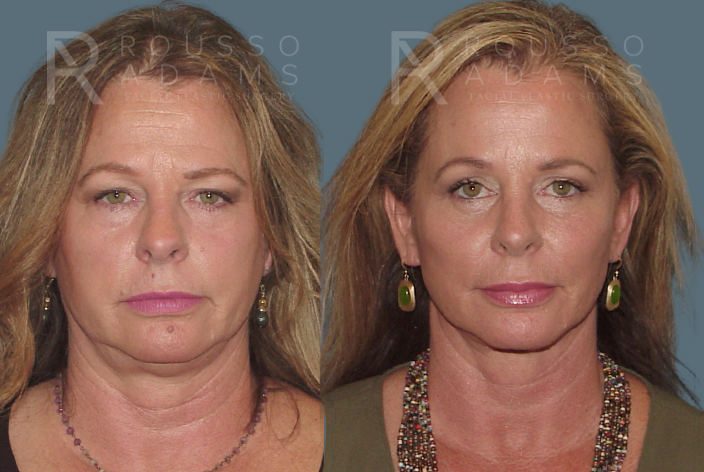 Blepharoplasty<span class=small>By Dr. Austin Adams</span> Before & After Gallery - Patient 146647263 - Image 2