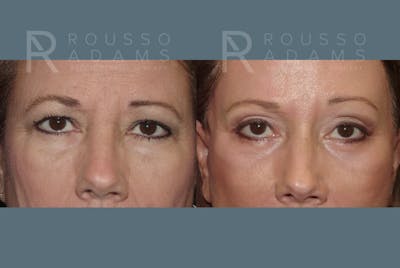 Blepharoplasty Before & After Gallery - Patient 146647264 - Image 1