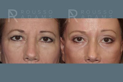 Blepharoplasty<span class=small>By Dr. Austin Adams</span> Before & After Gallery - Patient 146647264 - Image 1